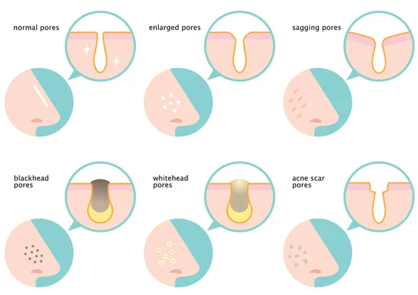 Sada Kožní Póry Nose Normální Chřadnoucí Zvětšené Uher Whitehead Akné — Stockový vektor