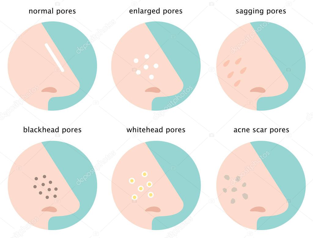 set of skin pores on nose: normal, sagging, enlarged, blackhead, whitehead,  and acne scar
