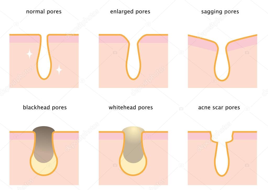 set of skin pores: normal, sagging, enlarged, blackhead, whitehead  and acne scar