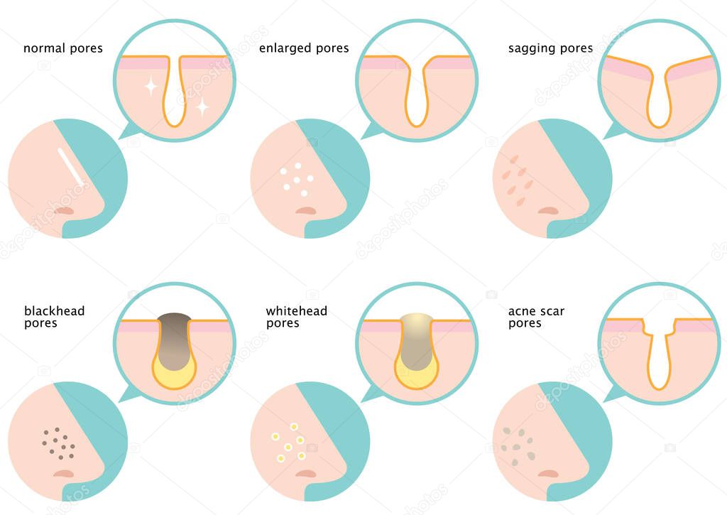 set of skin pores on nose: normal, sagging, enlarged, blackhead, whitehead  and acne scar