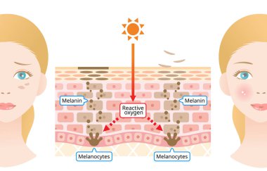 Melanin insan derisi mekanizması ve yüz koyu lekeleri. Infographic deri tabakası çizimi. Güzellik ve cilt bakımı