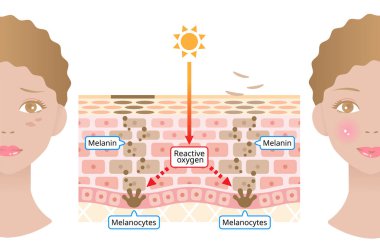 Melanin insan derisi mekanizması ve yüz koyu lekeleri. Infographic deri tabakası çizimi. Güzellik ve cilt bakımı
