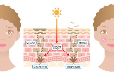 human skin mechanism of melanin and facial dark spots. Infographic skin layer illustration. Beauty and skin care concept clipart