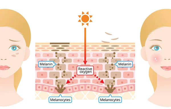 Melanin Insan Derisi Mekanizması Yüz Koyu Lekeleri Infographic Deri Tabakası — Stok Vektör