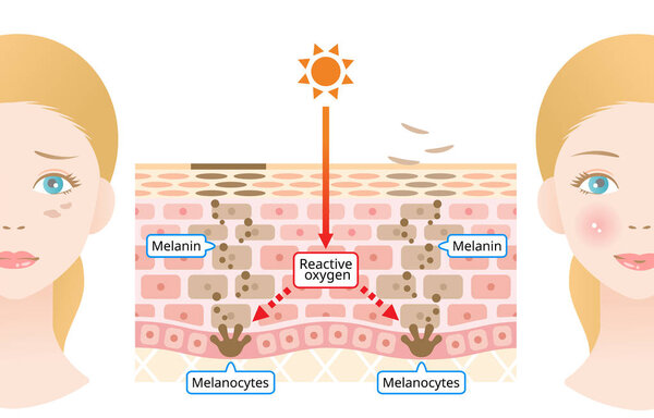 Механизм кожи человека меланина и темные пятна на лице. Инфографическая иллюстрация слоя кожи. Красота и уход за кожей
