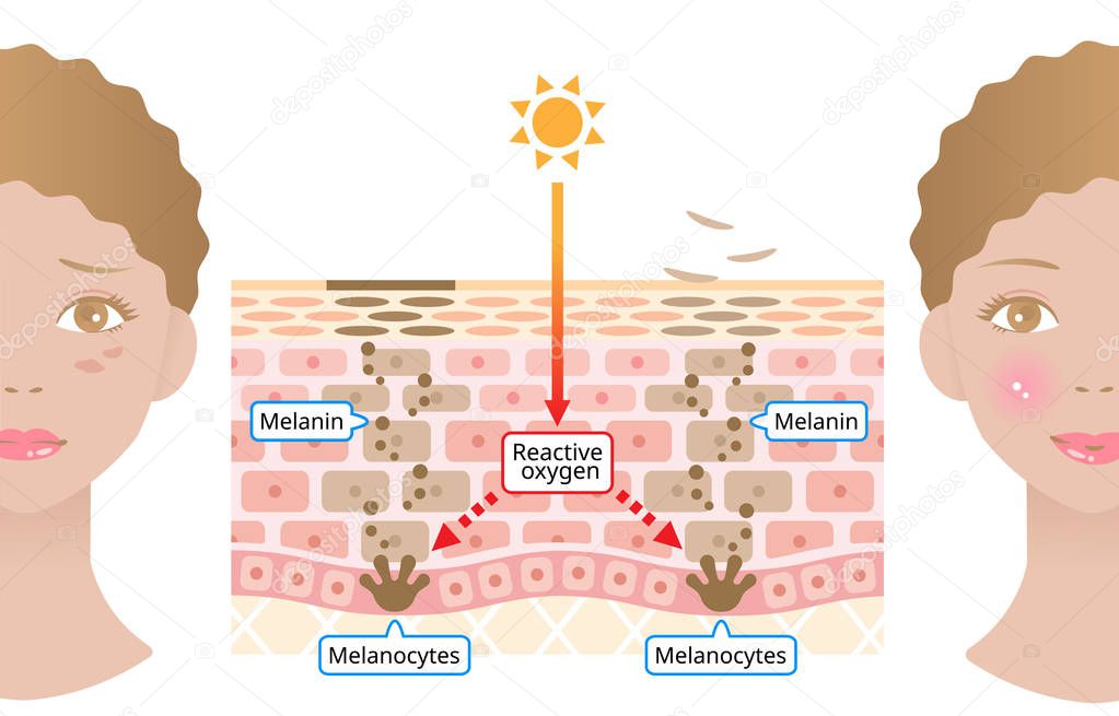human skin mechanism of melanin and facial dark spots. Infographic skin layer illustration. Beauty and skin care concept