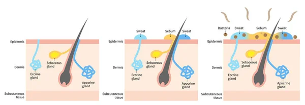 Diagram Body Odor Sweat Glands Human Skin Layer Illustration Medical — Stock Vector