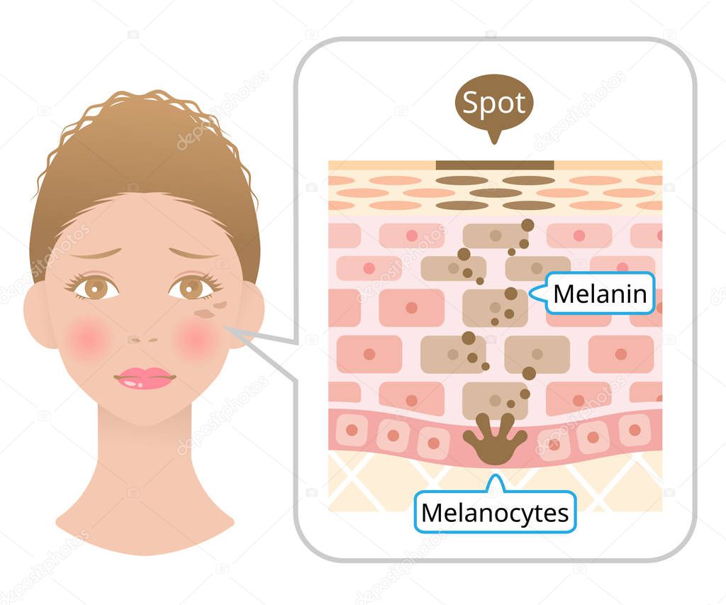 human skin layer with facial spot anatomy. Diagram of Melanin and melanocytes in black woman face. beauty and skin care concept