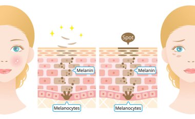 skin cell turnover and caucasian woman face. Melanin and melanocytes in human skin layer with woman face. beauty and skin care concept clipart
