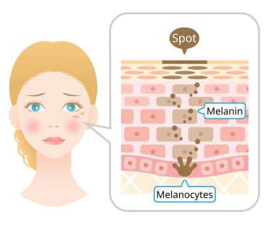 Yüz lekesi anatomisi ve beyaz kadın yüzü. Melanin diyagramı ve insan derisinde melanosit. Beyaz arkaplanda izole