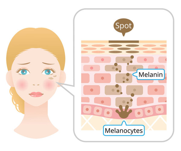 Анатомия пятна на лице и лицо белой женщины. Диаграмма меланина и меланоцитов в коже человека. Изолированный на белом фоне
