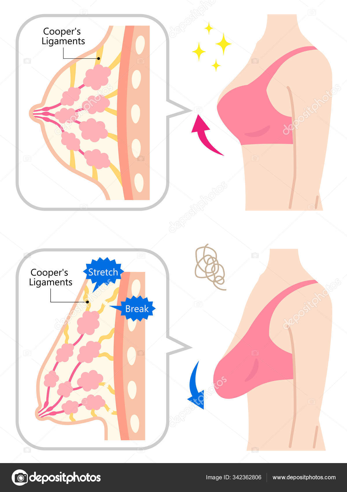 Sagging Woman Breast with Woman Upper Body. Isolated on White Background  Stock Vector - Illustration of busts, body: 198386371