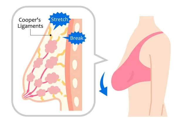 Slappe Borsten Vrouwen Lichaam Illustratie Schoonheid Lichaam Gezondheidszorg Concept — Stockvector