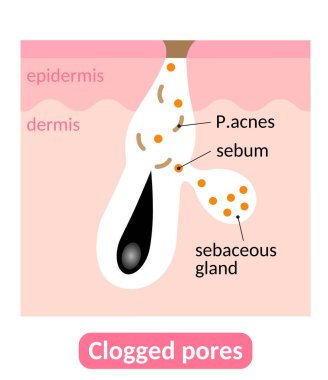 Sebum tıkaçları tıkanmış gözeneklere neden olur, bu da sivilcelere yol açar. Cilt bakımı kavramı