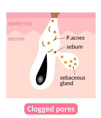 Sebum plugs causes clogged pores, which lead to acne. Skin care concept clipart