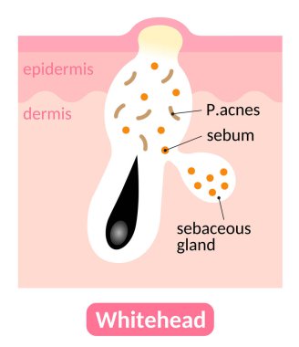 Whiteheads are types of acne pimples which are closed within the pore. Skin care concept clipart