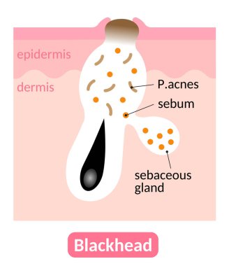 Blackheads are small bumps that appear on skin due to clogged pores. Skin care concept clipart