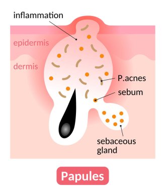 papules are type of inflamed blemish which is red bump on the skin. skin care concept clipart