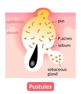 acne pustule is an inflamed skin pore clogged with pus. skin care concept clipart