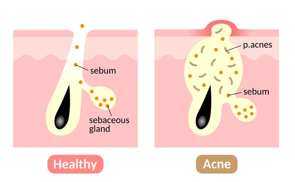 Proses Pembentukan Jerawat Jenis Jerawat Kulit Sehat Sebum Plug Whitehead - Stok Vektor