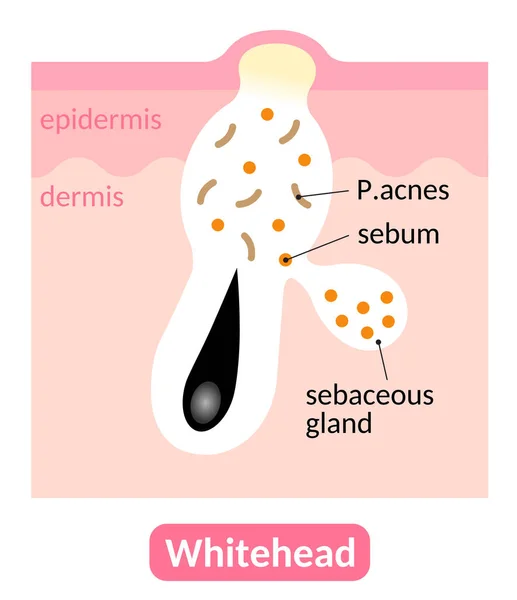 Whiteheads Sont Des Types Boutons Acné Qui Sont Fermés Dans — Image vectorielle