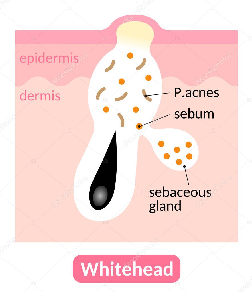 Whiteheads are types of acne pimples which are closed within the pore. Skin care concept