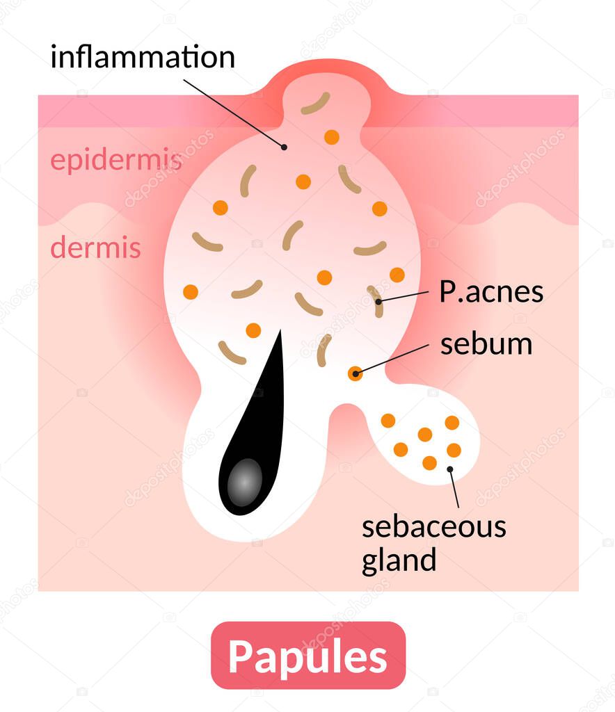 papules are type of inflamed blemish which is red bump on the skin. skin care concept