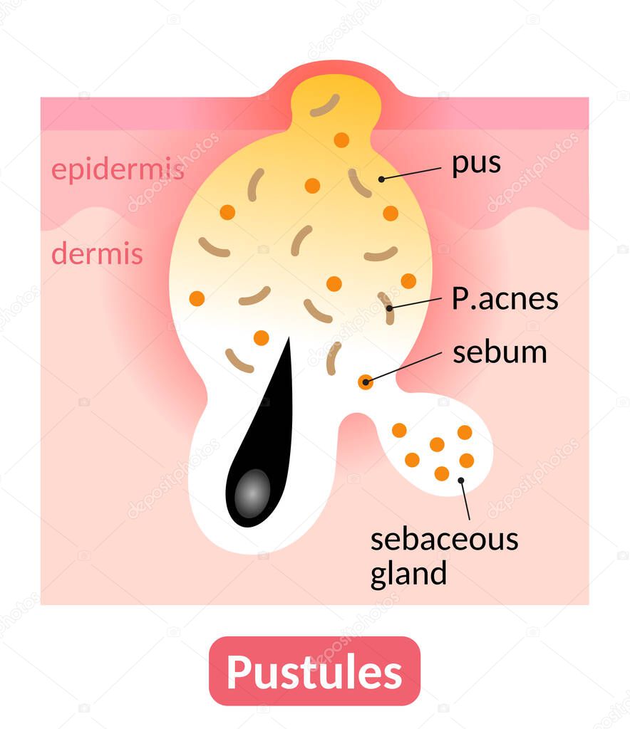 acne pustule is an inflamed skin pore clogged with pus. skin care concept