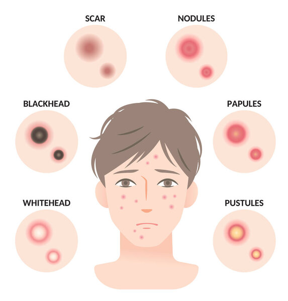 Types of acne and man face illustration. whitehead,black head, papules, and pustules. men's beauty skin care concept