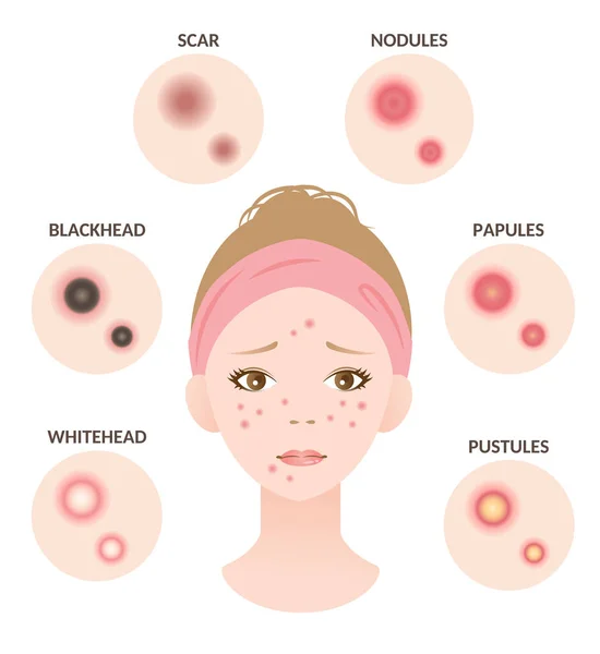 Tipos Acne Mulher Ilustração Facial Cabeça Branca Cabeça Preta Pápulas —  Vetores de Stock