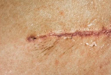 Yüz derisinden ameliyat üstüne dikiş atın. Arkadan bir kas flepinin cerrahi nakli. Dikilmiş bir yara, yakın plan iplikçikler. Yara kabukları iyileşiyor..