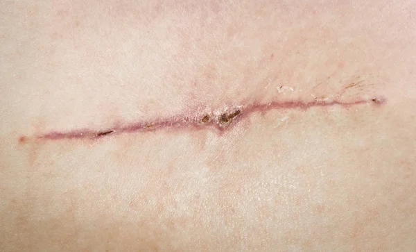 Suture after surgery on the skin of the face back. Surgical transplantation of a muscle flap from the back. A stitched wound of self-priming threads, close-up. Scabs on a healing wound.