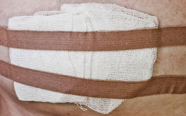 Gauze dressing and hypoallergenic adhesive plaster on the wound. Antibacterial protection and treatment of an open wound.
