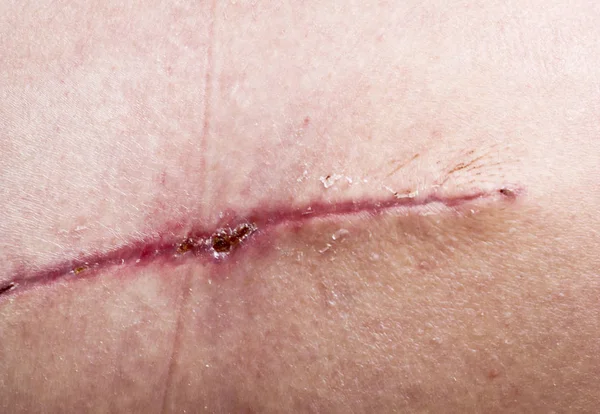 Yüz Derisinden Ameliyat Üstüne Dikiş Atın Arkadan Bir Kas Flepinin — Stok fotoğraf