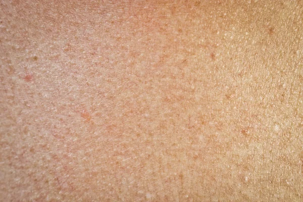 Texture Human Skin Freckles Age Spots — 스톡 사진