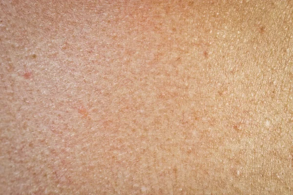 Texture Human Skin Freckles Age Spots — Stock Photo, Image