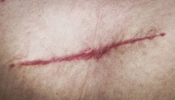 Healing chirurgic suture, postoperative wound. Red scar on human skin.