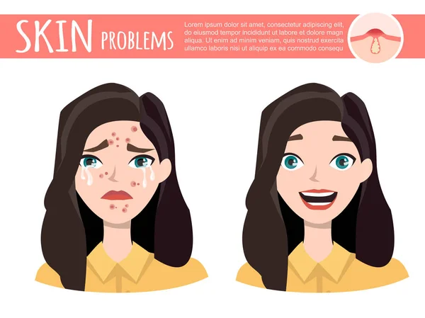 Acne treatment before after, facial cleansing foam, cartoon illustration — Stock Vector