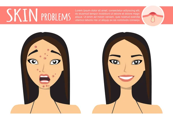 Tratamento da acne antes depois, espuma de limpeza facial, ilustração dos desenhos animados —  Vetores de Stock