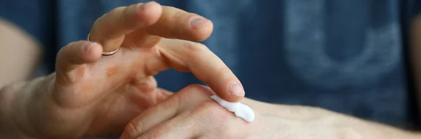 Male hands applying moistening cream on skin — Stock Photo, Image