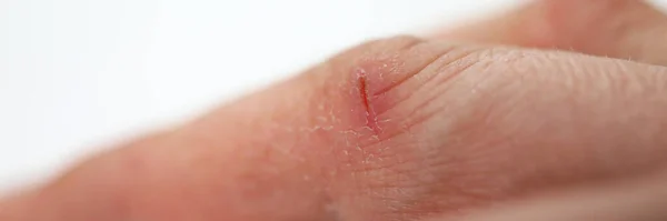 Parmağında küçük bir yara, derisinde kuru eller. — Stok fotoğraf