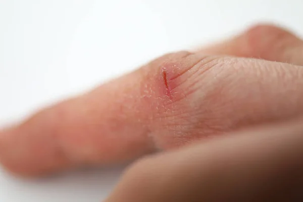 Close-up kleine wond aan de vinger, droge handen — Stockfoto