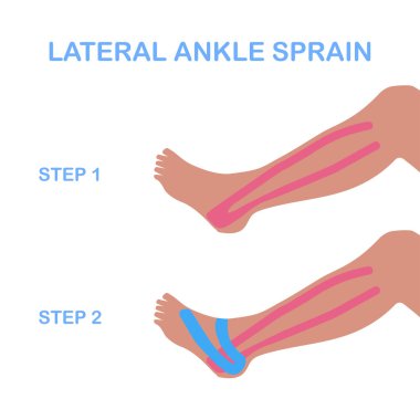 Lateral ayak bileği burkulması. Kinesiyoloji taping düzeltmek. 