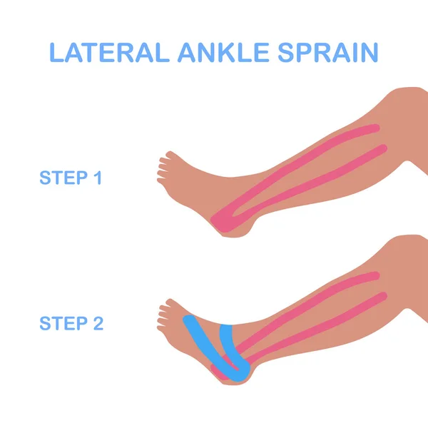 Lateral ayak bileği burkulması. Kinesiyoloji taping düzeltmek. 