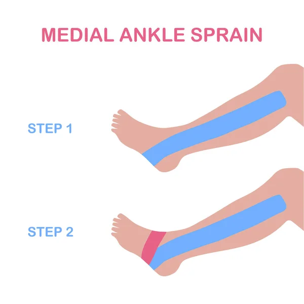 Esguince de tobillo medial. Grabación correcta de cinesiología . — Vector de stock