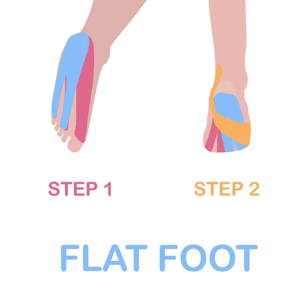 Plattfot. Korrigera kinesiologi tejpning. — Stock vektor
