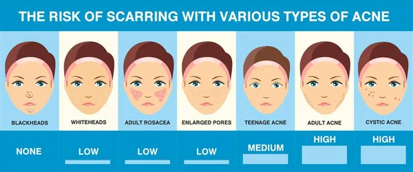 Cicatrici da acne. Diversi tipi di acne. Infografica. Problemi della pelle — Vettoriale Stock