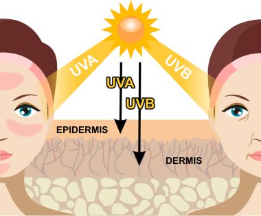 Güneş ışığındaki 2 tip radyasyon farkı cilde zararlıdır. UVA ve UVB ışınları arasındaki farkı gösteren bilgiler. İnsan derisine ve kadın yüzüne ultraviyole ışınlar..