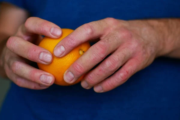 The man has psoriasis. Allergy to citrus. Close-up of hands.
