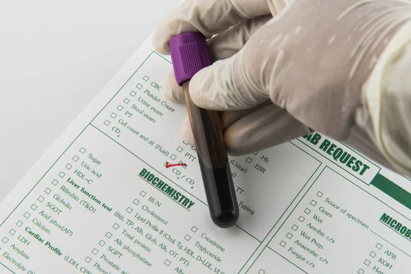 Blod rekvisitionen test för Hiv i laboratorium, Blood tube test — Stockfoto